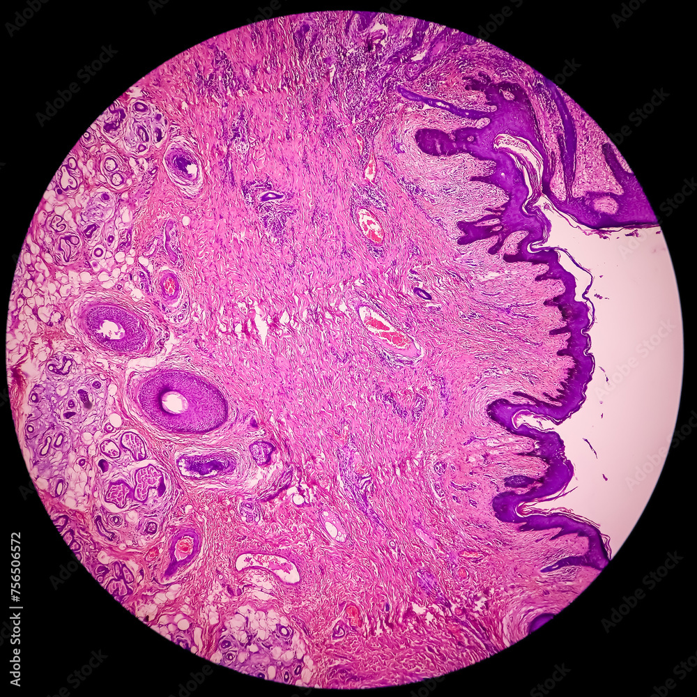 Wall mural Tissue from axilla (biopsy). Invasive squamous cell carcinoma. Smear show skin, invasive squamous cell carcinoma. Skin cancer.