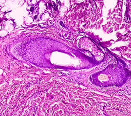 Tissue from axilla (biopsy). Invasive squamous cell carcinoma. Smear show skin, invasive squamous cell carcinoma. Skin cancer.