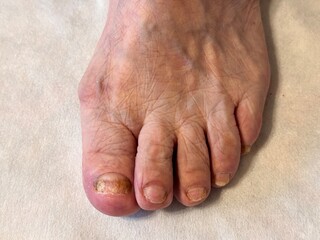 Fungal infection of the nails on the toenail of an elderly person. Close-up.