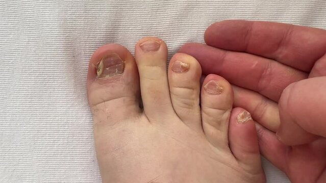 Close-up of the person nails affected by nail plate fungus. Ugly toes. Onycholysis of nails. Close-up.