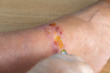 doctor treats large healing wound from on lower leg with scars of adult patient, inflammation and...