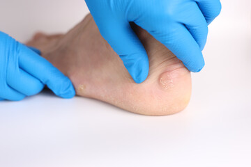 Obraz na płótnie Canvas A doctor examines calluses on a man's feet. Treatment of corns on the feet.