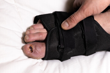 Man in orthopedic walking boots with broken big toe. The nail fell off the finger. Injury, fracture...