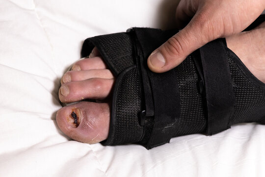 Man in orthopedic walking boots with broken big toe. The nail fell off the finger. Injury, fracture toe. Treatment of injured man's leg.