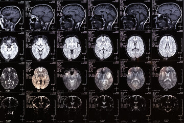 MRI, MRT, CT scan image of human brain. Medical treatmant concept. Diagnosis of the disease humans...
