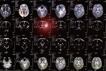 MRI, MRT, CT scan image of human brain. Medical treatmant concept. Diagnosis of the disease humans head.