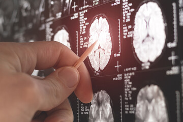 Doctor examining  MRI, MRT, CT scan.image of human brain. Medical treatmant concept. Diagnosis of...