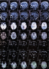 Vertical photo MRI, MRT, CT scan.image of human brain. Medical treatmant concept. Diagnosis of the disease humans head.