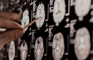 Doctor examining  MRI, MRT, CT scan.image of human brain. Medical treatmant concept. Diagnosis of...