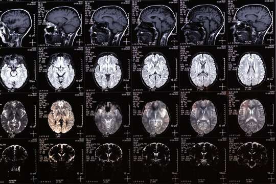 MRI, MRT, CT scan image of human brain. Medical treatmant concept. Diagnosis of the disease humans head.