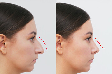 profile of woman's face with nose before and after rhinoplasty isolated on a white background. The...