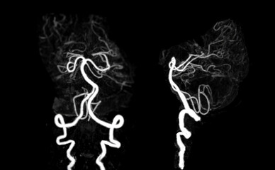 Fototapeta premium CT angiography of the brain or CTA brain showing noraml cerebral artery.