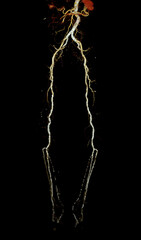 CTA femoral artery run off image of femoral artery for diagnosis  Acute or Chronic Peripheral Arterial Disease.