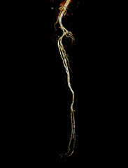 CTA femoral artery run off image of femoral artery for diagnosis  Acute or Chronic Peripheral Arterial Disease.