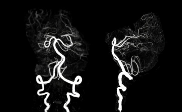 CT angiography of the brain or CTA brain showing noraml cerebral artery.
