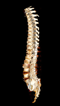  CT scan of thoracic and lumbar spine 3d rendering showing pedicle screw implant after surgical decompression and spinal fusion.