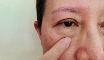 portrait showing the fingers holding the flabbiness and flabby skin, dark spots and blemish on the face, wrinkle and loose beside the eyelid of the woman, health care and beauty concept.