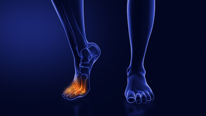 Ball of foot pain or Metatarsalgia - obrazy, fototapety, plakaty