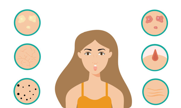 Young girl has skin problems with acne or allergic pimples on her face. Skincare and dermatology concept. Flat style vector illustration.