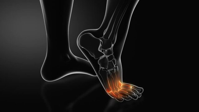 Metatarsalgia or Ball of Foot Pain