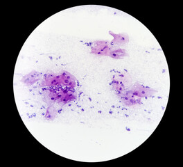 Light micrograph of Paps smear: Inflammatory smear with HPV related changes. Cervical cancer. SCC...