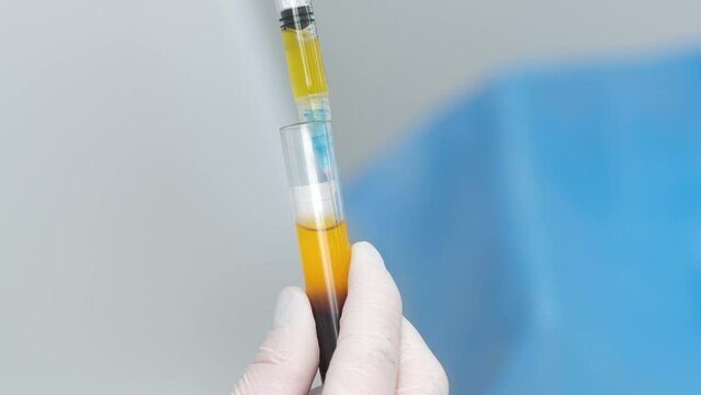 Doctor cosmetologist draws blood plasma into a syringe for the plasmolifting procedure, hands in gloves closeup. PRP therapy treatment in beauty clinic. Cure of problem skin.