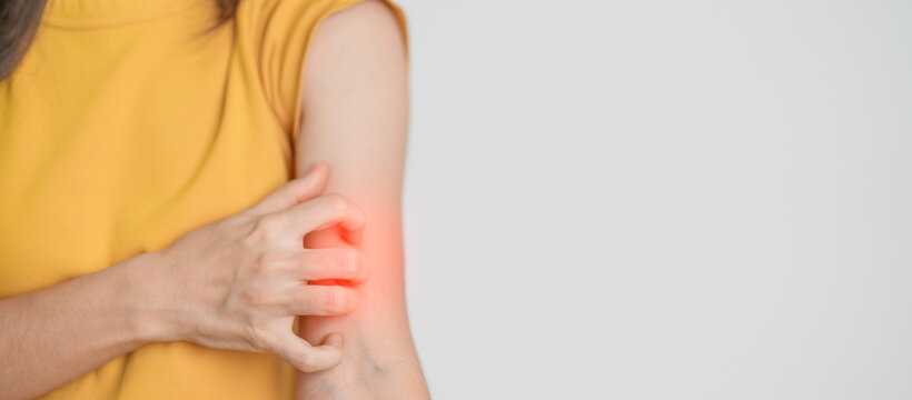 woman itching and scratching itchy arm. Sensitive Skin Allergic reaction to insect bite, food, drug dermatitis. Dermatology, Leprosy day, Systemic lupus erythematosus, Allergy symptoms and rash Eczema