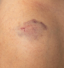 blue bruise on the skin of the arm.