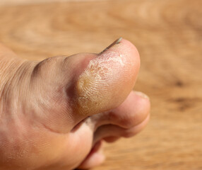 dry rough skin on toes as background.