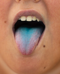blue tongue in a child from dyes