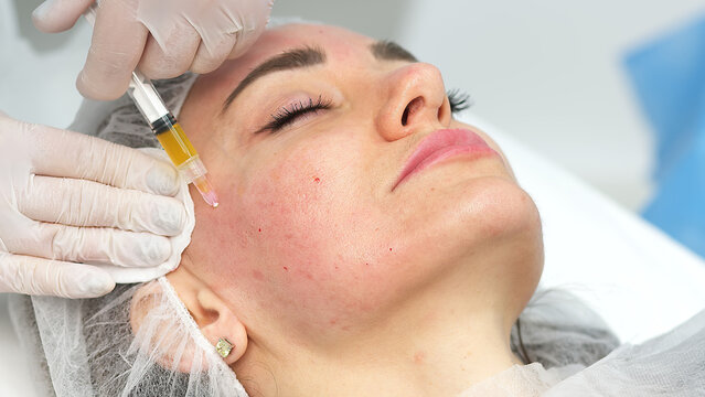 Medical cosmetology of plasma injections. Cosmetology, facial injections close-up. A professional cosmetologist, doctor does mesotherapy, plasma therapy to a young woman.