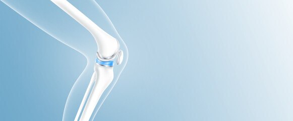 Total knee replacement or implant for treatment relieve arthritis, after joint damaged. Leg bone and cartilage side with copy space for text. Medical health care science technology concept. 3D vector.