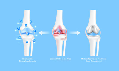 Leg bone and cartilage ligament. Osteoporosis or arthritis joint. Nourish with dietary supplements and Innovation medical technology treatment. Knee replacement surgery or implant. 3D vector.