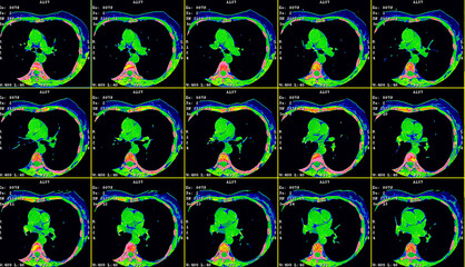 Axial contrast of the cardio system with radiology. A computerized tomography (CT) coronary angiogram