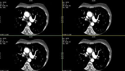 Axial contrast of the cardio system with radiology. A computerized tomography (CT) coronary...
