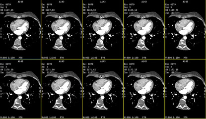 Axial contrast of the cardio system with radiology. CT Coronary angiography