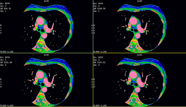 Axial contrast of the cardio system with radiology. CT Coronary angiography