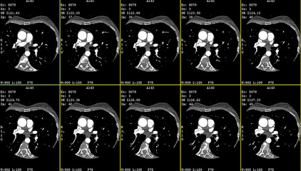  A computerized tomography CT coronary angiogram. Axial contrast of the cardio system with radiology