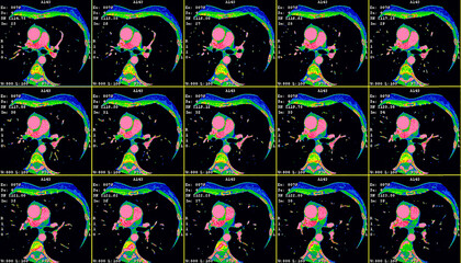 Axial images showing a thymic carcinoma CT cardiac scan. Computer tomography image of the heart