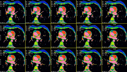 Angio CT cardiac scan. Computer tomography image of the heart