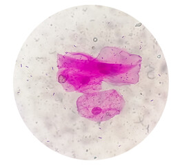Microscopic close view of high vaginal swab Gram stain smear, 40x. diagnosis of Bacterial vaginosis...