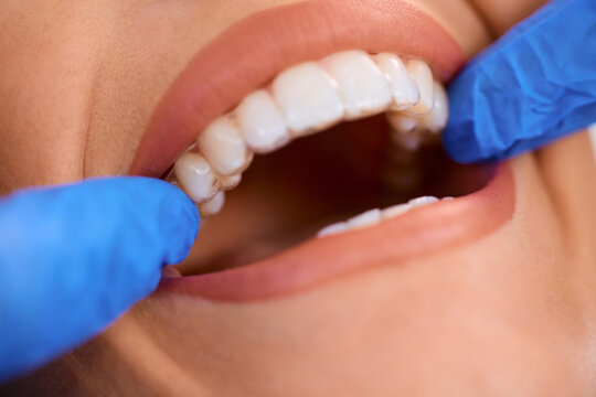 Close up of woman receiving transparent braces on her teeth at dentist's office,