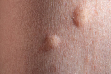 detailed macro shot of human skin with mosquito bite