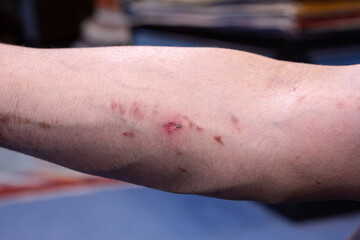 Acid Burn Scars on Human Arm