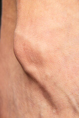 Close-Up of a Protruding Bone Spur on Human Skin