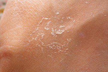 Close-up Texture of Dry Human Skin Peeling Off