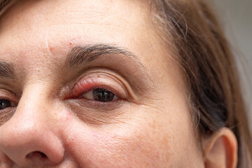Close-Up on Woman's Face Showing Signs of Eye Infection