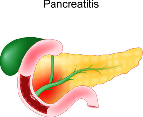 Acute pancreatitis. Duodenum, gallbladder and pancreas.