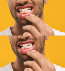 Man showing gum before and after treatment on orange background, collage of photos