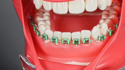 teeth with green bracket